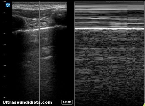 M-MODE, NORMAL PLEURAL SLIDE