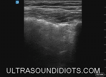Ultrasound Idiots — pneumothorax