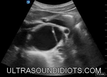 Aortic Dissection Ultrasound