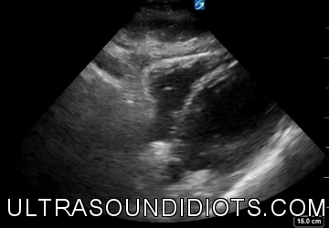 eFast protocol in trauma ultrasound