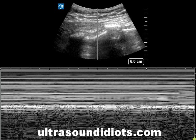 M-MODE, PNEUMOTHORAX