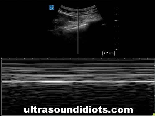 M-MODE, PNEUMOTHORAX