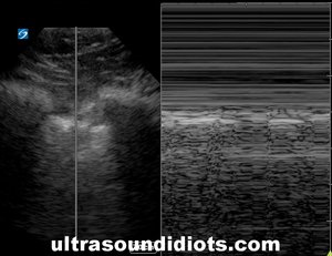 M-MODE, NORMAL PLEURAL SLIDE