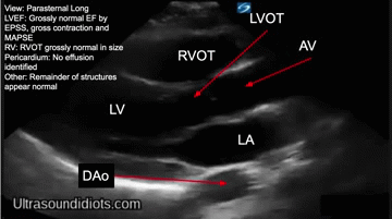 Ultrasound Idiots — limited echo, limited echocardiography, point of care  ultrasound, point-of-care-ultrasound, pocus,