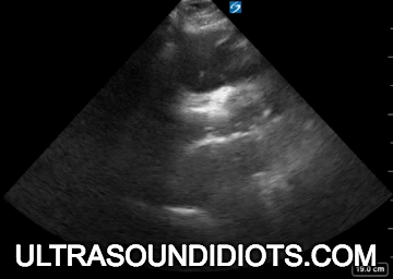 Ultrasound Idiots — Type A Dissection