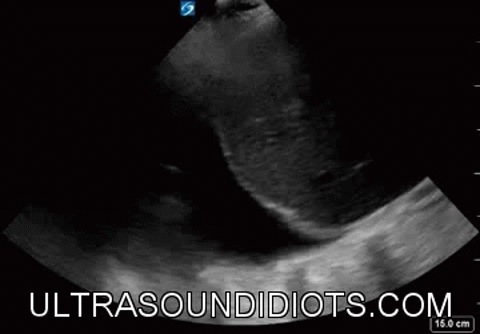 Free fluid in the pleural space (above the diaphragm)