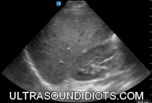 Ultrasound Idiots — Trauma / EFAST