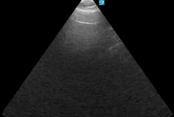 CASE 1_PULM EDEMA.gif