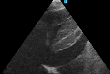 CASE 1_ IVC.gif