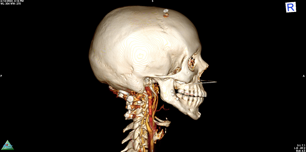 Eagles-syndrome-full-skull-imaging-3D-CAT-scan.jpg