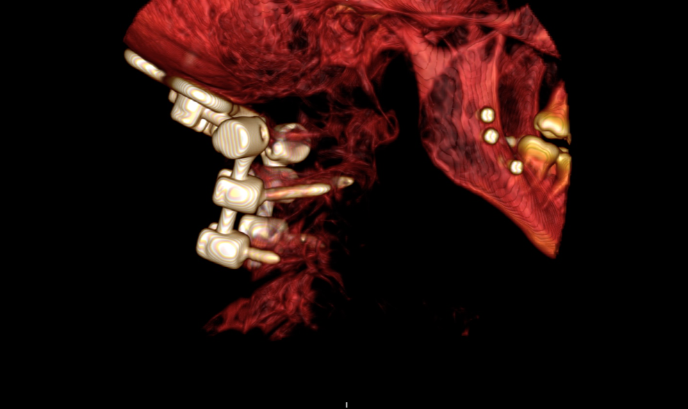 Ehlers-Danlos-Cranial-cervical-instability-fusion-c1-c3-Dr-patel.jpg