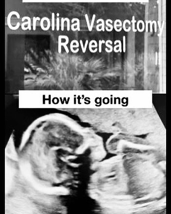 Tom&rsquo;s River, NJ 
Vasectomy 2005
Vasectomy Reversal 2021
#vasectomyreversal #vasectomyreversalbaby #vasectomyreversalsuccessstory #carolinavasectomyreversal
