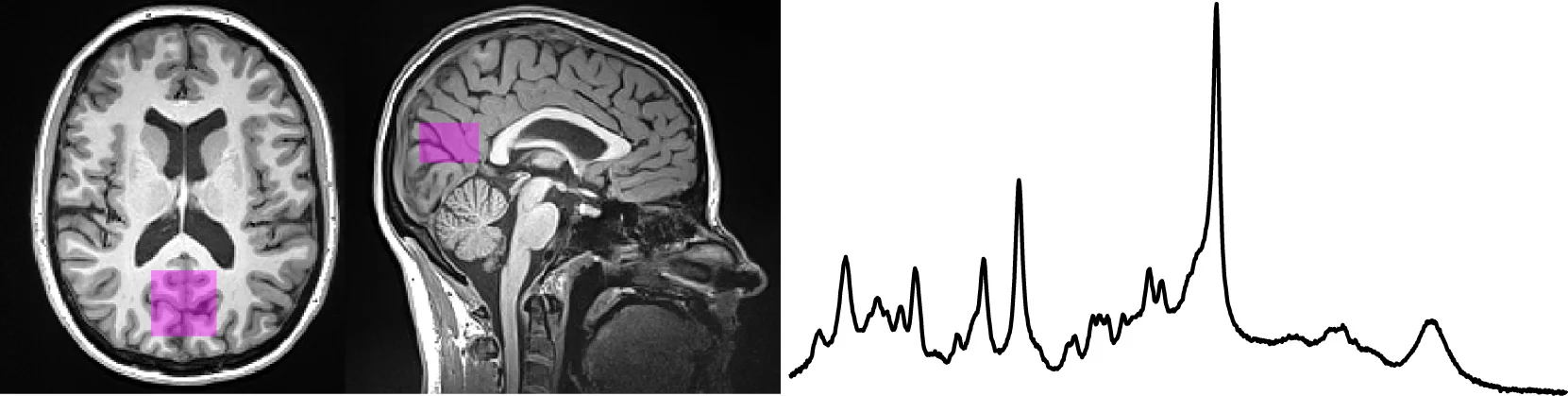 Localized proton magnetic resonance spectroscopy for measurements of neurochemical concentrations in the human brain.
