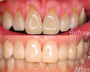 How green tea helps gum disease. Via Oralcare Home