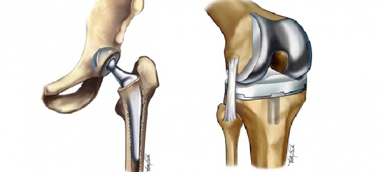 Physical Therapy for joint replacements.
