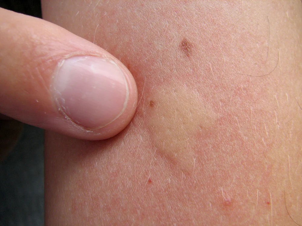 mosquito-bite-on-human-swollen-Mosquito-Squad-of-Chelmsford.jpg
