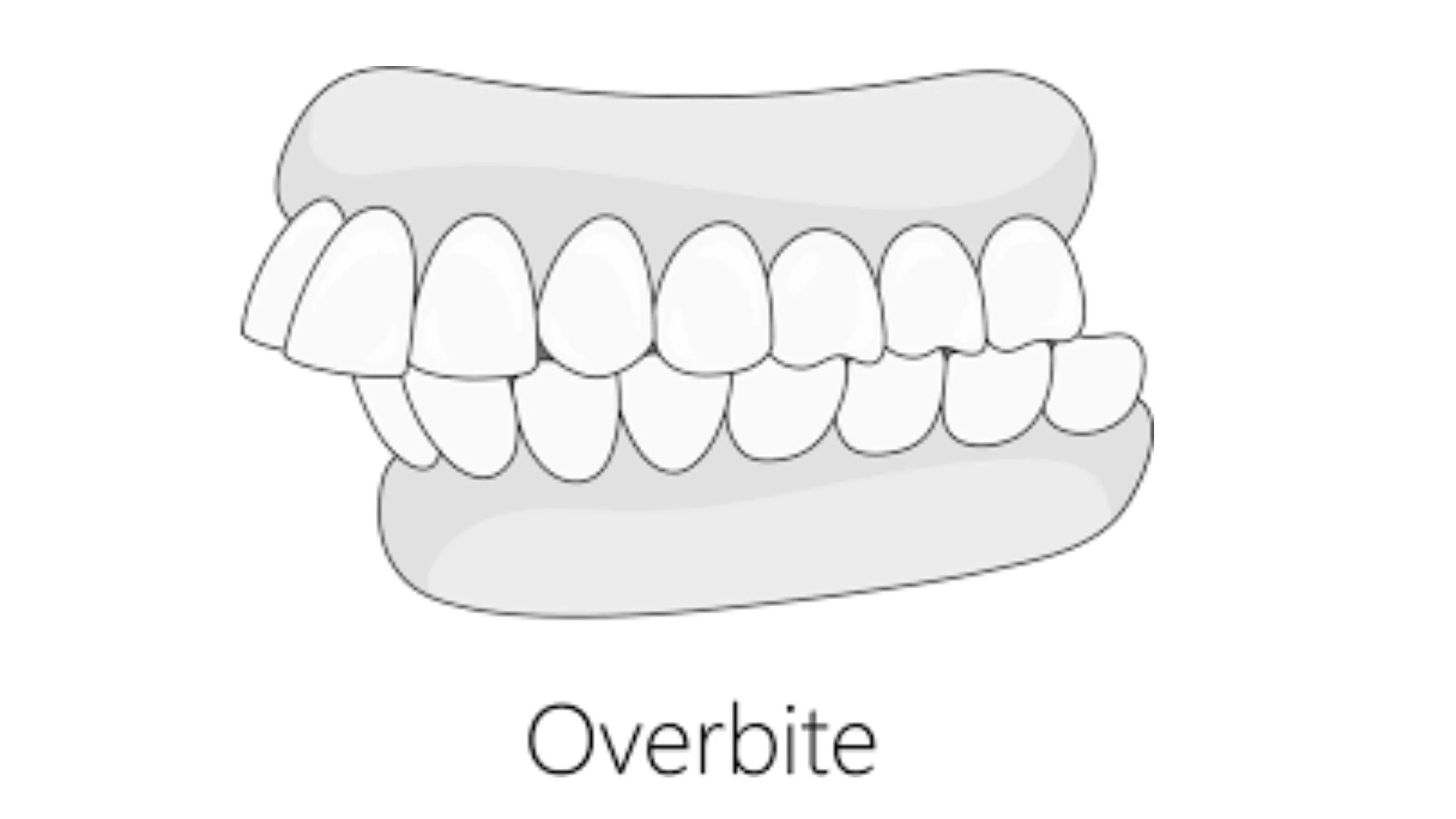 Over bite — Hugo Orthodontics