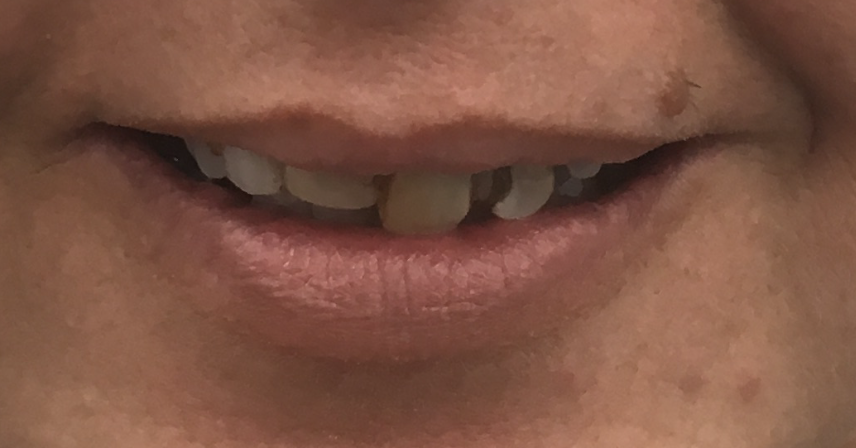 Before<br>Complete Smile Makeover