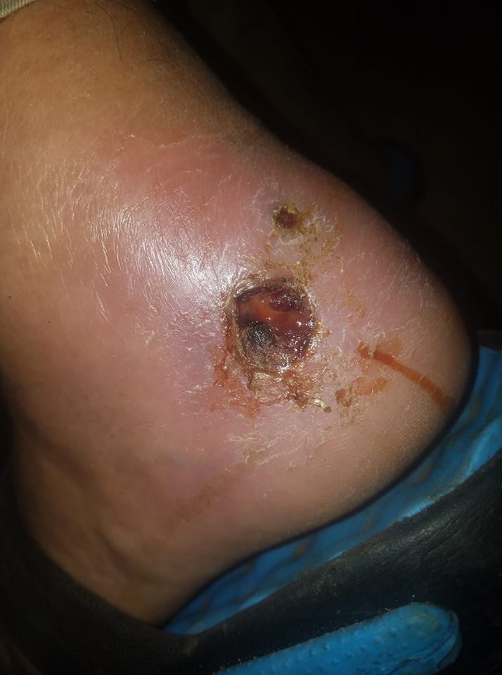 jeffs infected foot