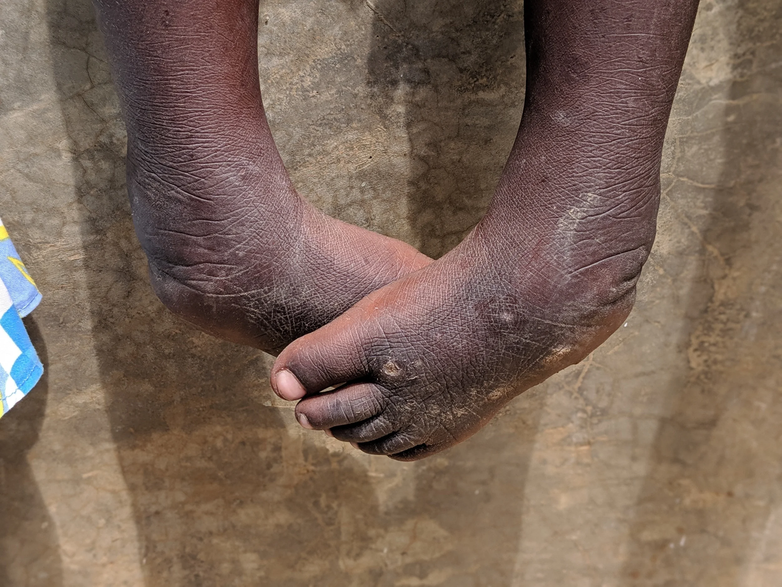 Kelly's clubbed feet which his sweet Mama also has.