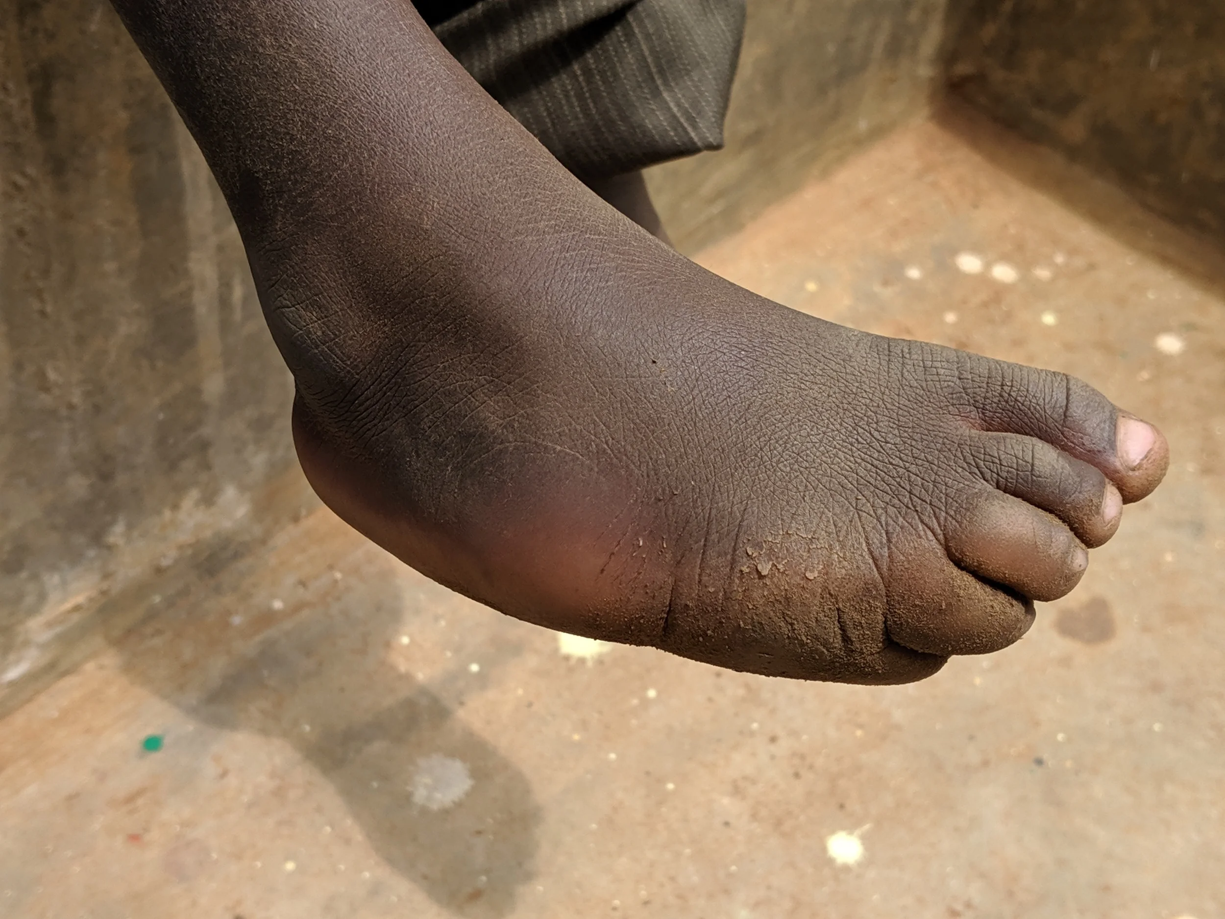 Ezekiel's clubbed foot.