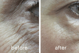 SKINADE_Anti-ageing results after 30 days.png