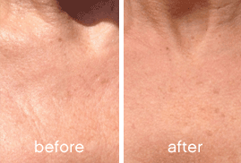 SKINADE_Anti-ageing results after 30 days_1.png