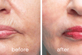 SKINADE_Anti-ageing results after 30 days_2.png