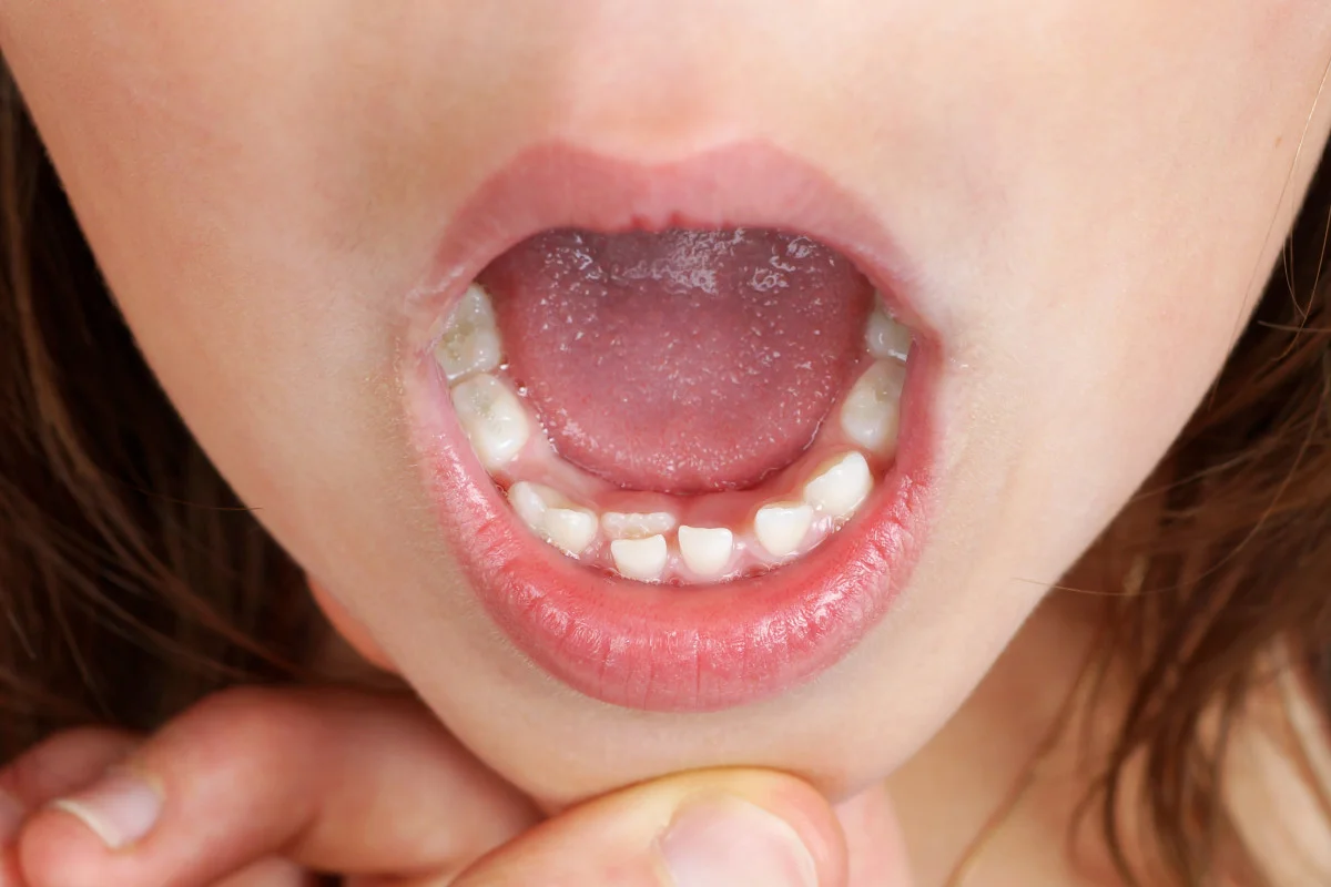 over-retained teeth (aka "shark teeth")