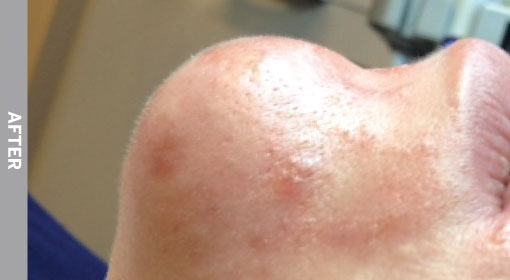 One session, one hour post treatment.