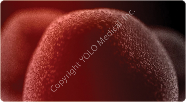 2. The YOLO Curve’s laser energy starts to irradiate the adipocytes.