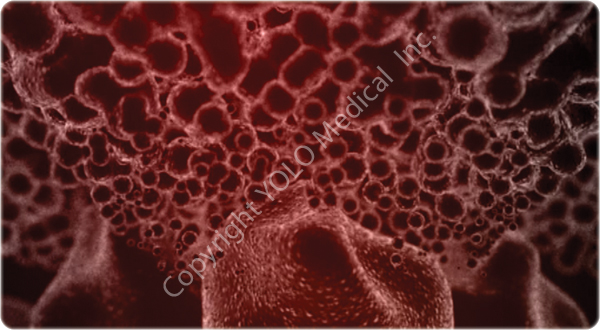 6. As the treatment continues, water, glycerol and free fatty acids enter the interstitial space.