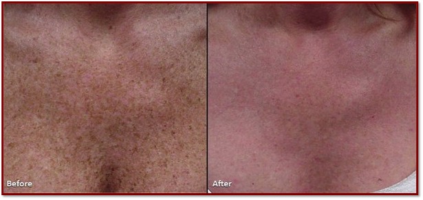  Z Medical Aesthetics IPL Photofacial Skincare Treatment Temple TX 