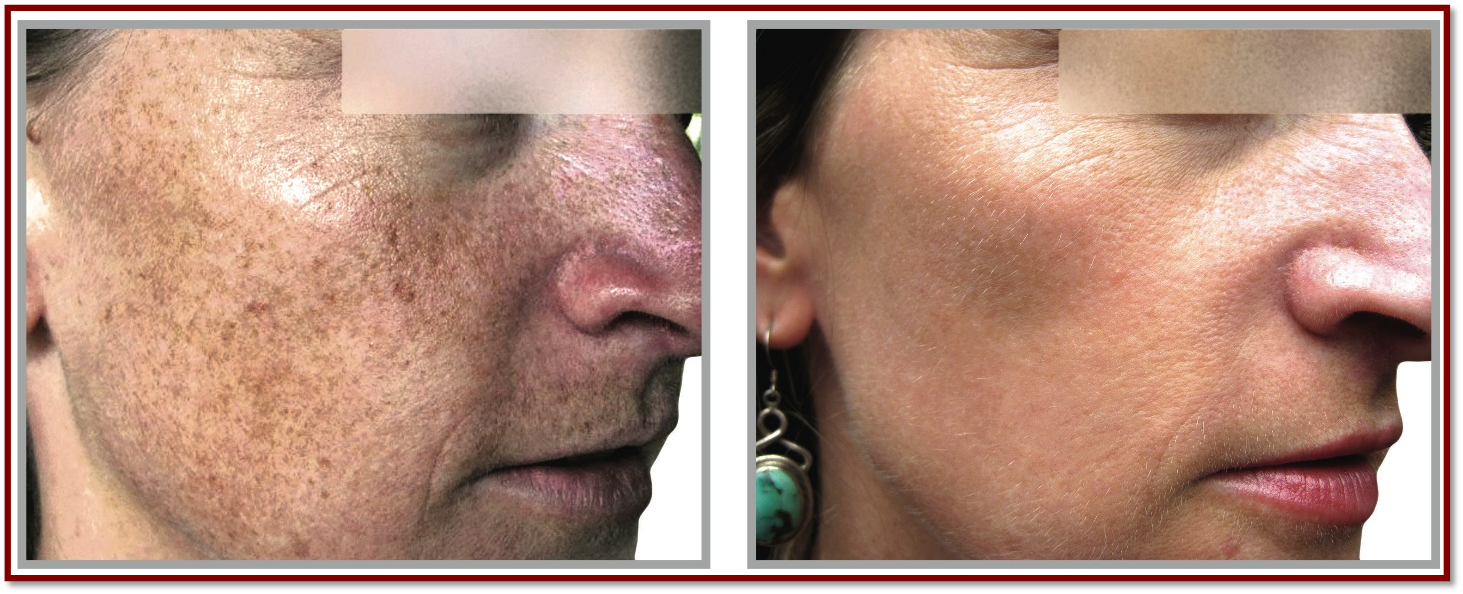 Z Medical Aesthetics IPL Photofacial Skincare Treatment Temple TX