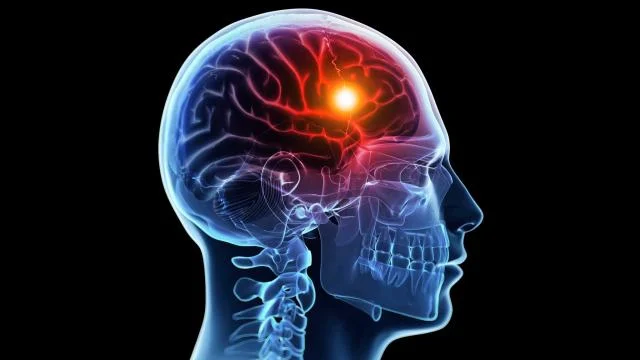 Brain-Attack-The-Truth-About-Strokes.jpg