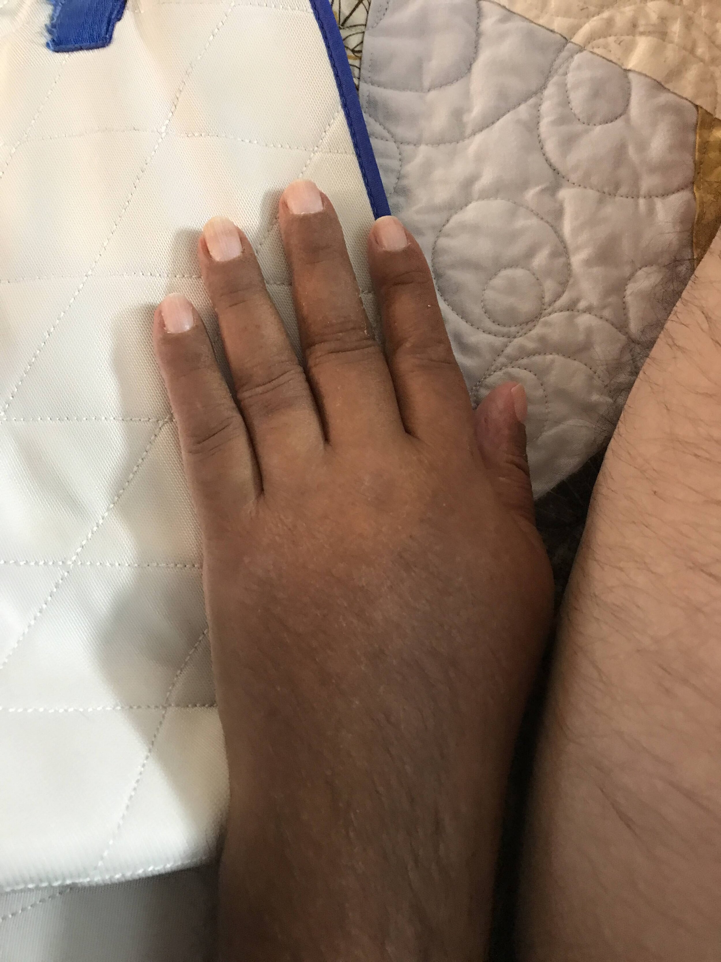 Swollen hands.jpg