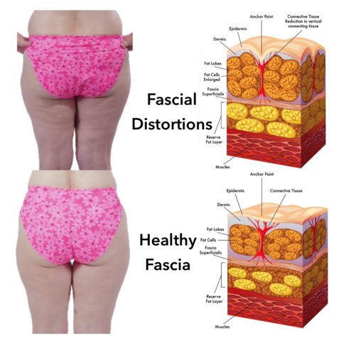 FasciaBlaster_cellulite_get_rid_of_cellulite_large.png