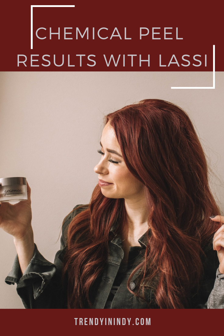 3- Chemical peel results with Lassi.png