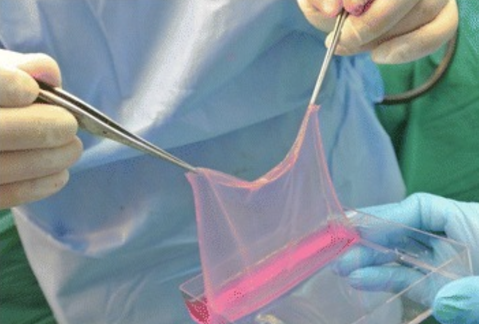 A Review of Cultured Epidermal Cells (CEA)