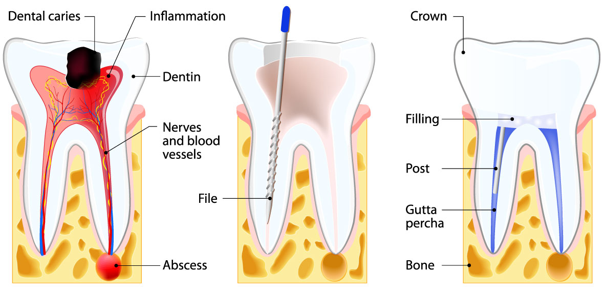 root-canal-terms.jpg