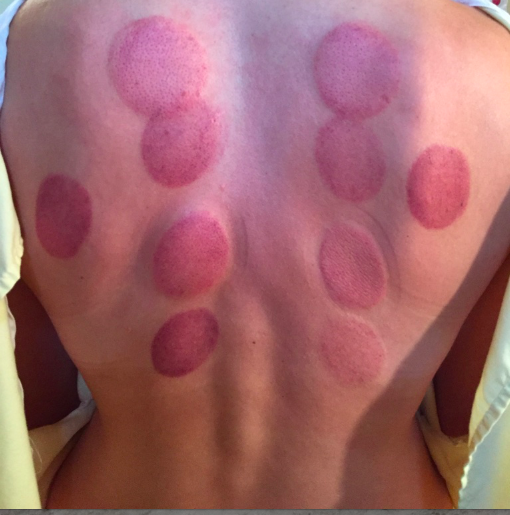 Cupping