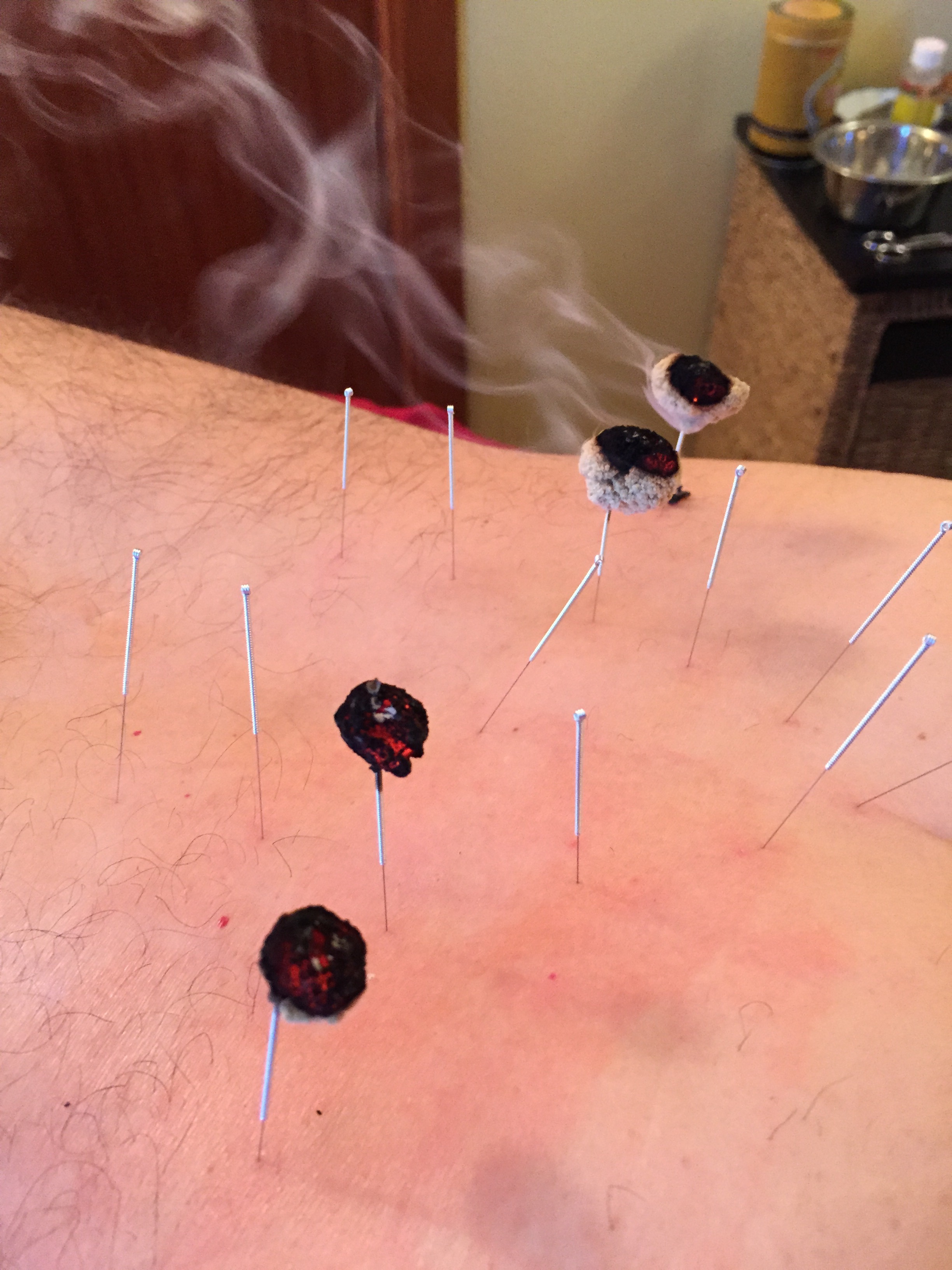 Moxa and needling