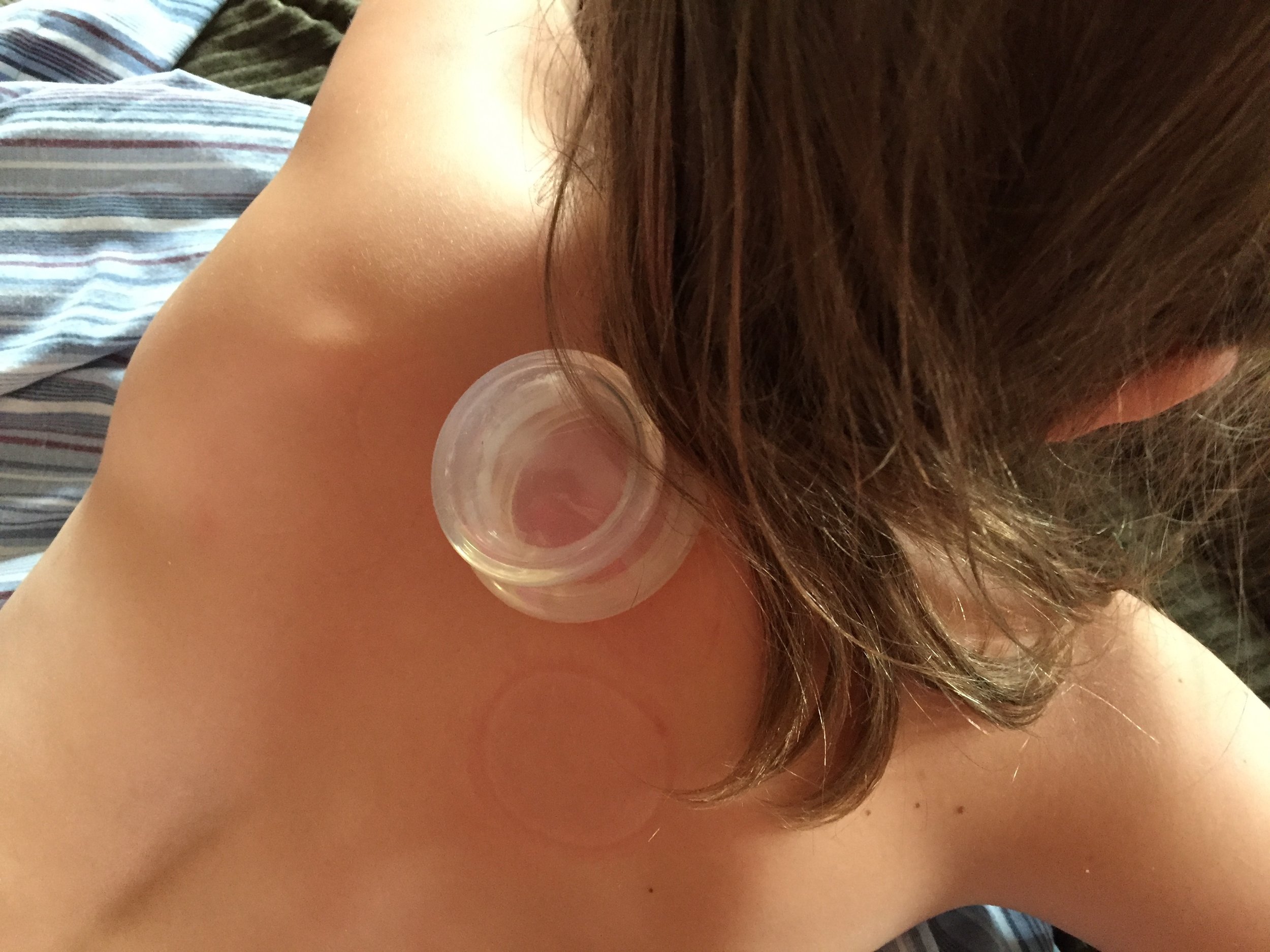 Cupping