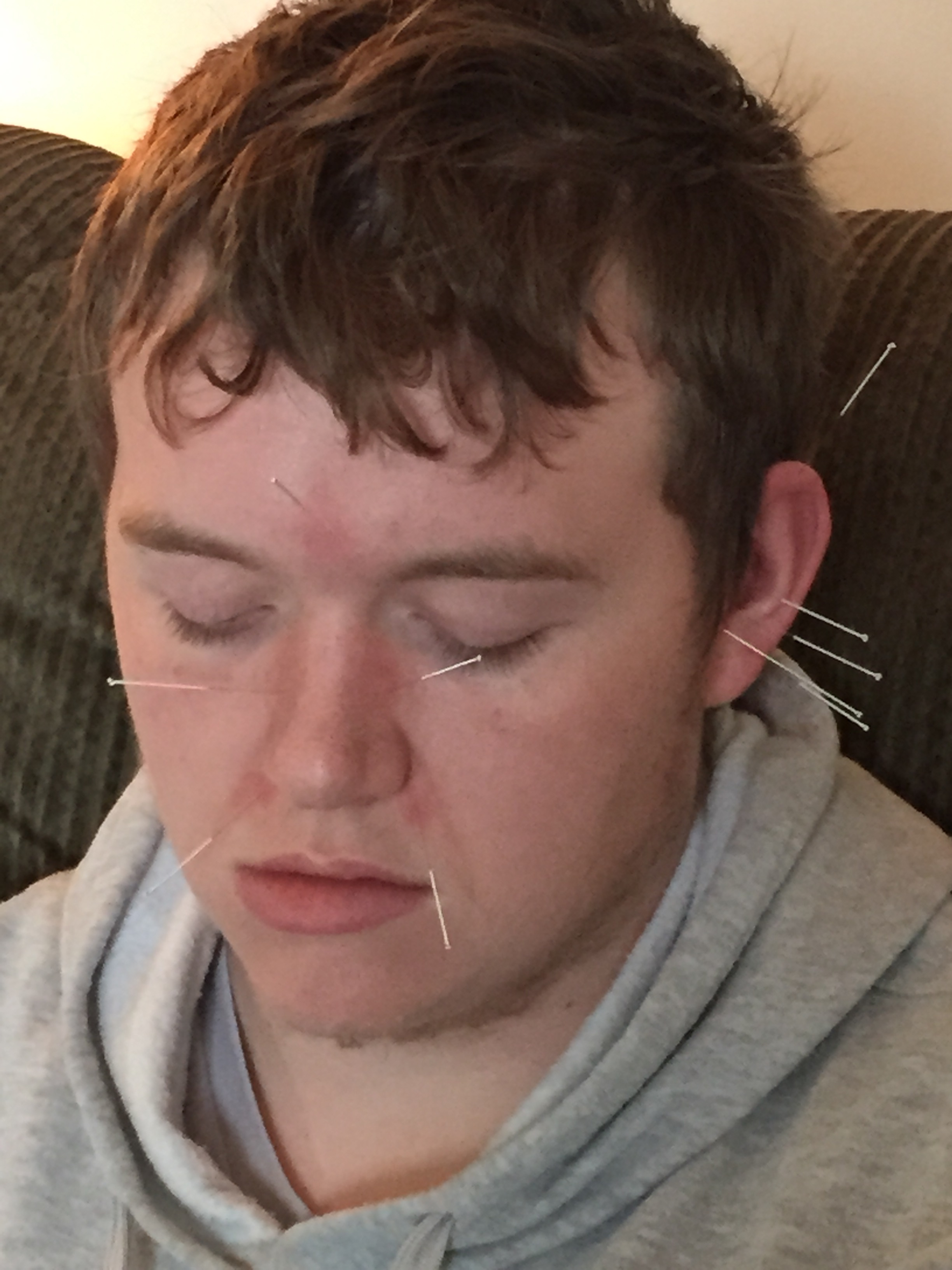 Acupuncture