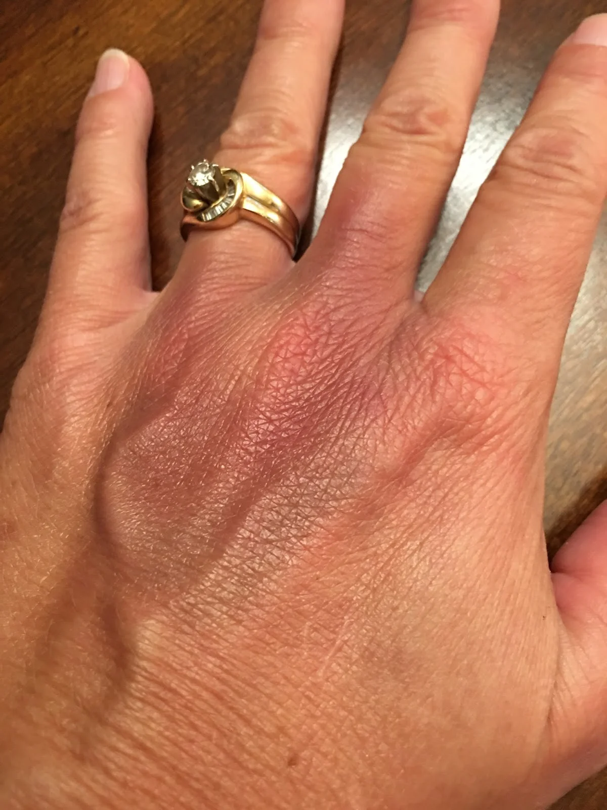Bruises.. Bruises everywhere. The day folding laundry became dangerous!!