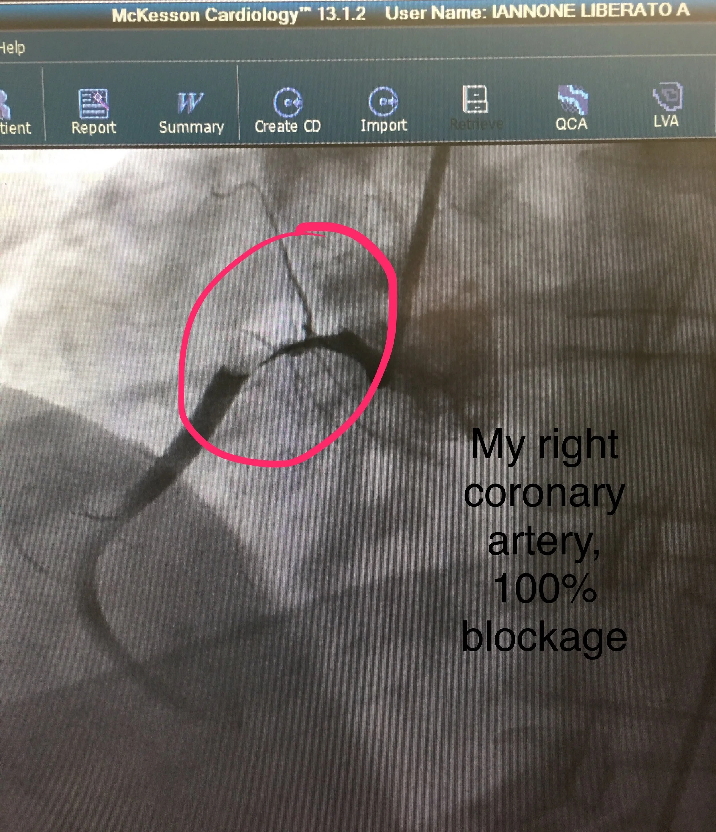 My Cath lab film showing 100% blockage of my right coronary artery