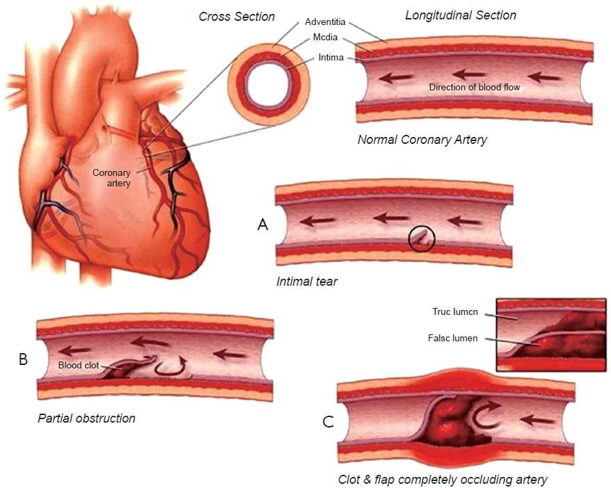 The image above is of the different degrees of S.C.A.D Sudden Coronary Artery Dissection. (Graphic by Journal of Thoracic Disease)