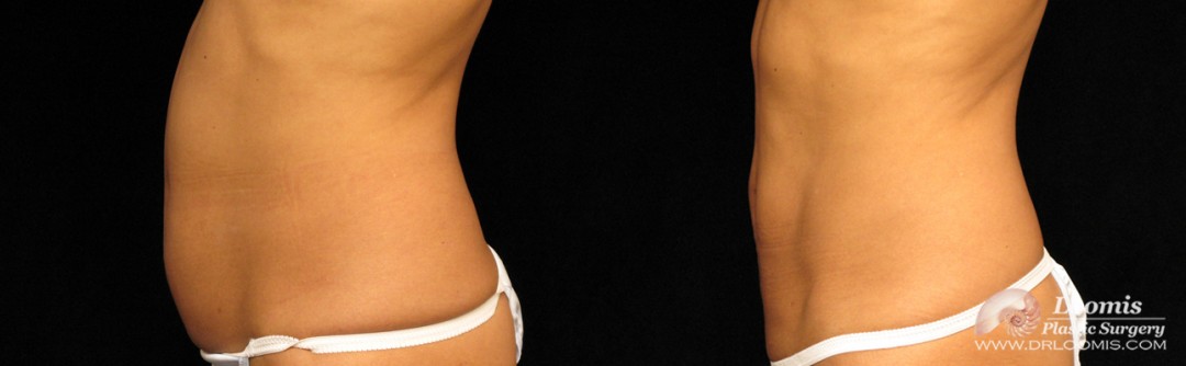 CoolSculpting® of abdomen