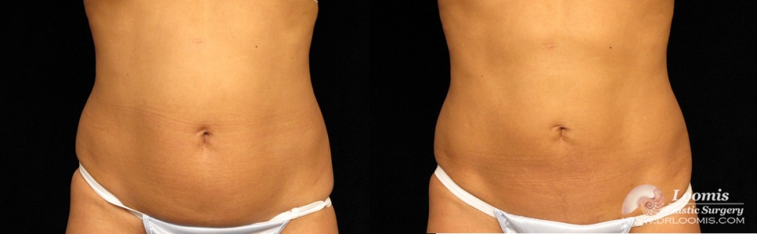 Abdomen fat freezing