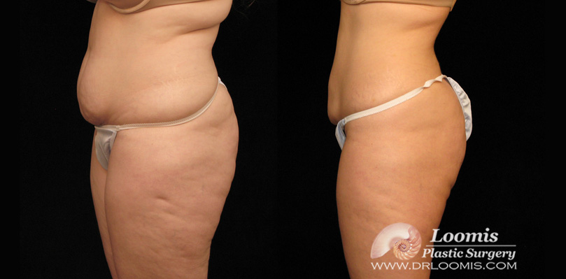 Nonsurgical body sculpting